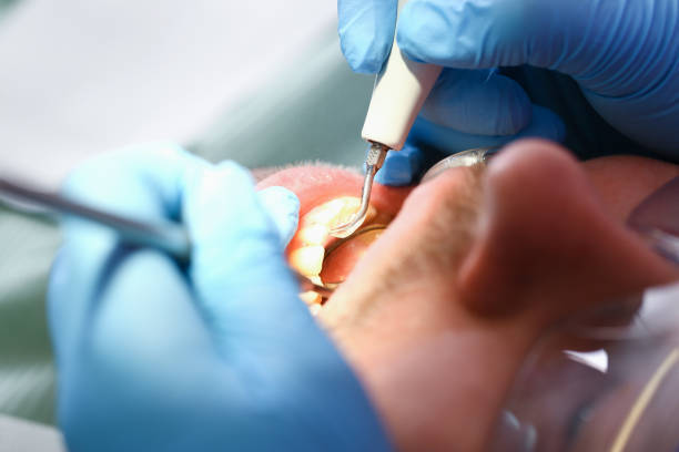 Best Emergency Tooth Extraction in Hillsborough, CA